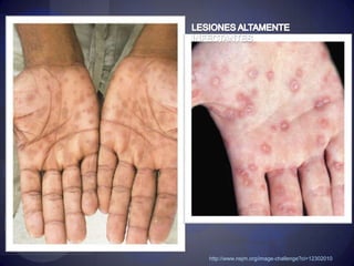 PLACAS ANULARES PERIBUCALESWolf, Allen Johnson "Fitzpatrick’s Color Atlas of clinical Dermatology"  6th edition. McGraw Hill