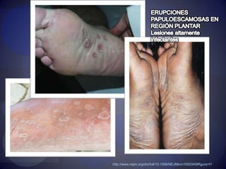 LESIONES ALTAMENTE INFECTANTEShttp://www.nejm.org/image-challenge?ci=12302010