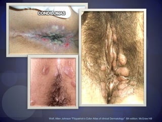 Revista "Medicina Clínica" Vol.124 Núm. 02 ElsevierVarón de 32 años, heterosexual, sin antecedentes personales de interés, que consultó por una pérdida difusa del pelo de la zona parietooccipital de 2 meses de evolución, por lo que el cuero cabelludo presentaba un «aspecto apolillado». En la exploración del resto de la superficie cutánea se apreciaban, en el área perianal, unas placas excrecentes, húmedas, con superficie plana, de 1 a 3 cm de diámetroLa analítica general fue normal, las serologías de VIH, VHB y VHC resultaron negativas y, sin embargo, se apreció serología luéica (RPR 1/8 y FTA-abs) positiva.Diagnóstico: Sífilis secundaria (alopecia y condilomas planos).