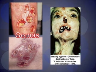 Sífilis terciariaCecchiniGonzalez, Silvia Ayala "Infectologia y Enfermedades Infecciosas" 1 ed. JournalManual CTO Infectología 7° Edición