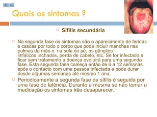 Quais os sintomas ? Sífilis secundária Na segunda fase os sintomas são o aparecimento de feridas e cascas por todo o corpo que pode incluir manchas nas palmas da mão e  na sola do pé, os gânglios linfáticos inchados, perda de cabelo, etc. Se for infectado e ficar sem tratamento a doença evoluirá para uma segunda fase. Esta segunda fase começa então de 6 a 12 semanas após o contacto com uma pessoa infectada e pode durar desde algumas semanas até mesmo 1 ano.  Periodicamente a segunda fase da sífilis é seguida por uma fase de latência. Durante a mesma se não tomar a medicação os sintomas irão desaparecer.  