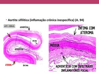 • Aortite sifilítica (inflamação crônica inespecífica) (A. 94)
 
