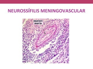NEUROSSÍFILIS MENINGOVASCULAR
 