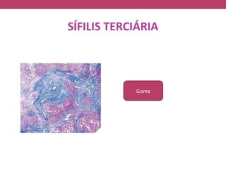 SÍFILIS TERCIÁRIA




            Goma
 