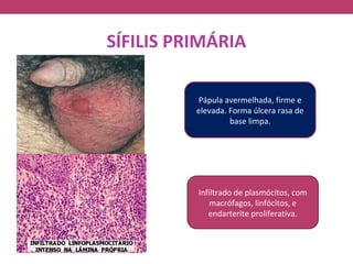 SÍFILIS PRIMÁRIA

          Pápula avermelhada, firme e
          elevada. Forma úlcera rasa de
                   base limpa.




          Infiltrado de plasmócitos, com
             macrófagos, linfócitos, e
             endarterite proliferativa.
 