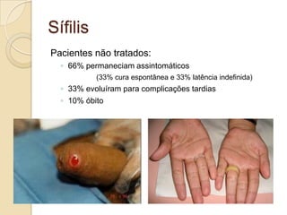 Sífilis
Pacientes não tratados:
◦ 66% permaneciam assintomáticos
(33% cura espontânea e 33% latência indefinida)
◦ 33% evoluíram para complicações tardias
◦ 10% óbito
 