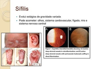 Sífilis
 Evolui estágios de gravidade variada
 Pode acometer: olhos, sistema cardiovascular, fígado, rins e
sistema nervoso central
 