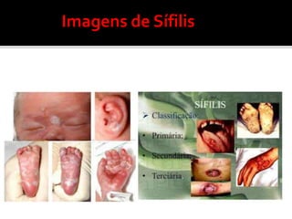 Imagens de Sífilis
 