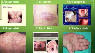 • Sífilis primária Sífilis latente Sífilis congênita
• Sífilis primária Sífilis terciária Sífilis decapitada
 