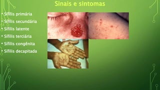 • Sífilis primária
• Sífilis secundária
• Sífilis latente
• Sífilis terciária
• Sífilis congênita
• Sífilis decapitada
 
