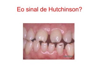 Eo sinal de Hutchinson?
 