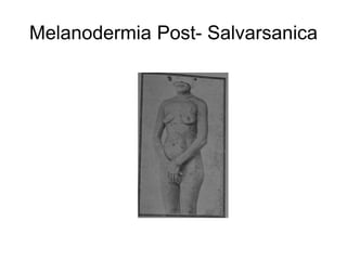 Melanodermia Post- Salvarsanica
 