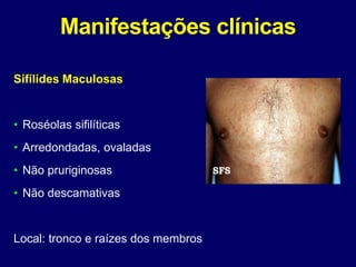 Manifestações clínicas
Sifílides Maculosas
• Roséolas sifilíticas
• Arredondadas, ovaladas
• Não pruriginosas
• Não descamativas
Local: tronco e raízes dos membros
 