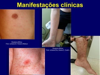 Manifestações clínicas
Roséola sifilítica
Foto: cortesia Dr. Rubens Matsuo
Roséola sifilítica
Foto: cortesia Dra. Ariane C. Coelho
 