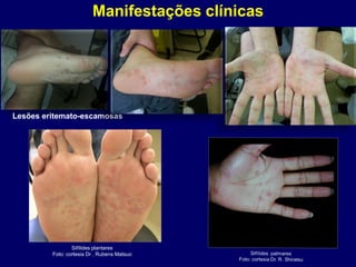 Manifestações clínicas
Lesões eritemato-escamosas
Sifílides plantares
Foto: cortesia Dr . Rubens Matsuo
 