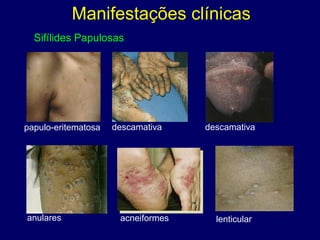 Sifílides Papulosas
papulo-eritematosa descamativa descamativa
anulares acneiformes lenticular
Manifestações clínicas
 