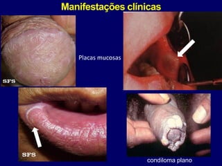 Manifestações clínicas
condiloma plano
Placas mucosas
 