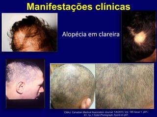 Manifestações clínicas
Alopécia em clareira
 