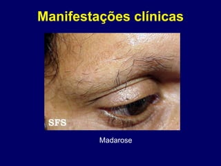 Madarose
Manifestações clínicas
 