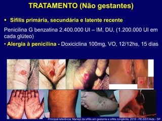 TRATAMENTO (Não gestantes)
 Sífilis primária, secundária e latente recente
Penicilina G benzatina 2.400.000 UI – IM, DU, (1.200.000 UI em
cada glúteo)
• Alergia à penicilina - Doxiciclina 100mg, VO, 12/12hs, 15 dias
Principal referência: Manejo da sífilis em gestante e sífilis congênita, 2016 - PE-DST/Aids - SP
 
