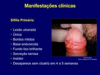 Manifestações clínicas
Sífilis Primária
• Lesão ulcerada
• Única
• Bordos nítidos
• Base endurecida
• Fundo liso brilhante
• Secreção serosa
• Indolor
• Desaparece sem cicatriz em 4 a 5 semanas
Cancro duro
Foto: cortesia Dr. R. Shiratsu
 
