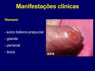 Manifestações clínicas
Homem
- sulco bálano-prepucial
- glande
- perianal
- boca
 