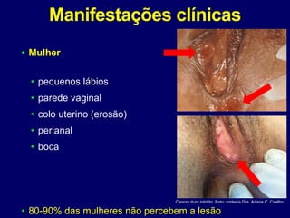 Manifestações clínicas
• Mulher
• pequenos lábios
• parede vaginal
• colo uterino (erosão)
• perianal
• boca
• 80-90% das mulheres não percebem a lesão
Cancro duro intróito. Foto: cortesia Dra. Ariane C. Coelho
 