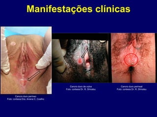 Manifestações clínicas
Cancro duro períneo
Foto: cortesia Dra. Ariane C. Coelho
Cancro duro de vulva
Foto: cortesia Dr. R. Shiratsu
Cancro duro perineal
Foto: cortesia Dr. R. Shiratsu
 
