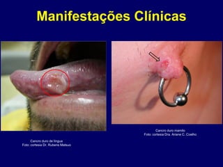Cancro duro de língua
Foto: cortesia Dr. Rubens Matsuo
Manifestações Clínicas
Cancro duro mamilo
Foto: cortesia Dra. Ariane C. Coelho
 