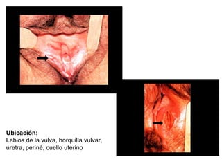 Ubicación:
Labios de la vulva, horquilla vulvar,
uretra, periné, cuello uterino
 