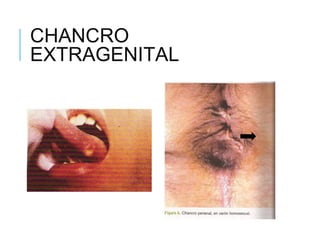 CHANCRO
EXTRAGENITAL
 