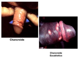 Chancroide
Chancroide
Escabiotico
 