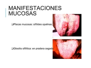 MANIFESTACIONES
MUCOSAS
❑Placas mucosas: sifílides opalinas
❑Glositis sifilítica: en pradera cegada
 