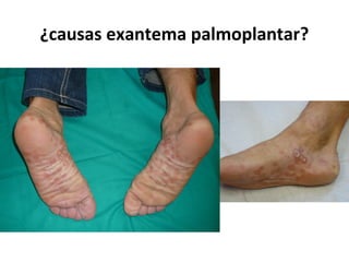 ¿causas exantema palmoplantar?
 
