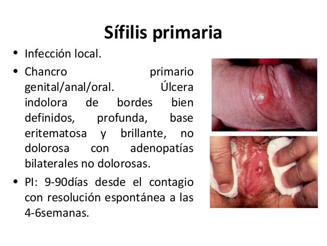 sfilis colgar 10 638