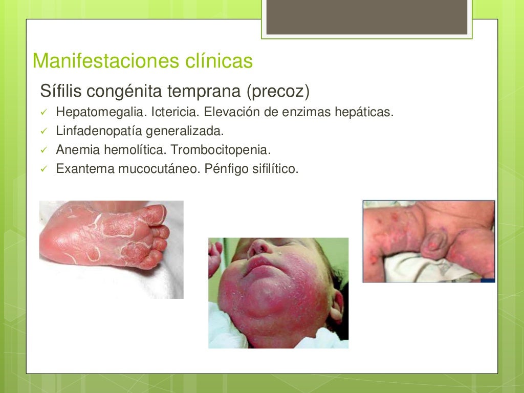 Sífilis congénita expo