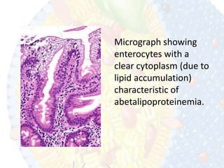 Abetalipoproteinemia | PPT