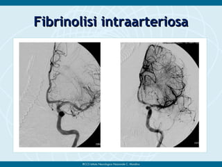 Fibrinolisi intraarteriosaFibrinolisi intraarteriosa
 