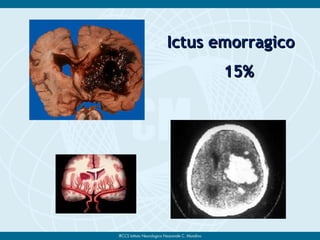 Ictus emorragicoIctus emorragico
15%15%
 