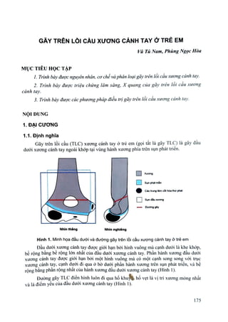 SGK Gãy trên lồi cầu xương cánh tay ở trẻ em Y4.pdf