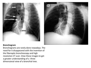 AlhityCough surgical review by dr bashar | PDF