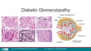 Diabetic Glomerulopathy
Clin J Am Soc Nephrol 12: 2032–2045, 2017 Am J Kidney Dis. 71(6):884-895,2018
 