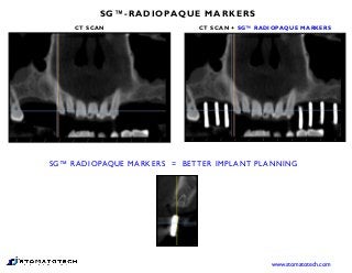 SG™-RADIOPAQUE MARKERS
CT SCAN CT SCAN + SG™ RADIOPAQUE MARKERS
SG™ RADIOPAQUE MARKERS = BETTER IMPLANT PLANNING
www.stomatotech.com
 