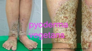 Know GI Inside & Out? Recognizing Skin Lesions of GI Disorders | PPTX
