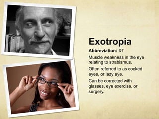 Exotropia
Abbreviation: XT
Muscle weakness in the eye
relating to strabismus.
Often referred to as cocked
eyes, or lazy eye.
Can be corrected with
glasses, eye exercise, or
surgery.
 