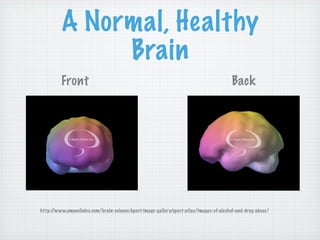 A Normal, Healthy
              Brain
         Front                                                                          Back




http://www.amenclinics.com/brain-science/spect-image-gallery/spect-atlas/images-of-alcohol-and-drug-abuse/
 