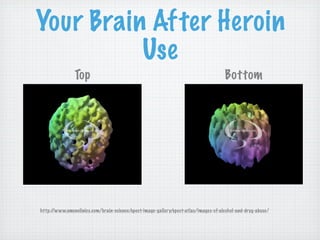 Your Brain After Heroin
          Use
               Top                                                                   Bottom




http://www.amenclinics.com/brain-science/spect-image-gallery/spect-atlas/images-of-alcohol-and-drug-abuse/
 