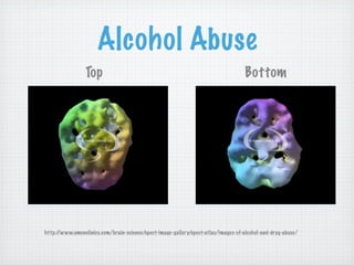 Alcohol Abuse
                 Top                                                               Bottom




http://www.amenclinics.com/brain-science/spect-image-gallery/spect-atlas/images-of-alcohol-and-drug-abuse/
 