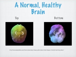 A Normal, Healthy
              Brain
          Top                                                                          Bottom




http://www.amenclinics.com/brain-science/spect-image-gallery/spect-atlas/images-of-alcohol-and-drug-abuse/
 