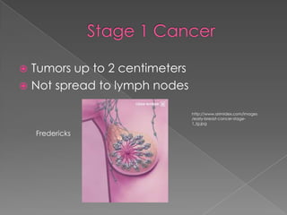 Stage 1 CancerTumors up to 2 centimetersNot spread to lymph nodeshttp://www.arimidex.com/images/early-breast-cancer-stage-1_lg.jpgFredericks
